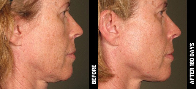 Ultherapy (Full Face)