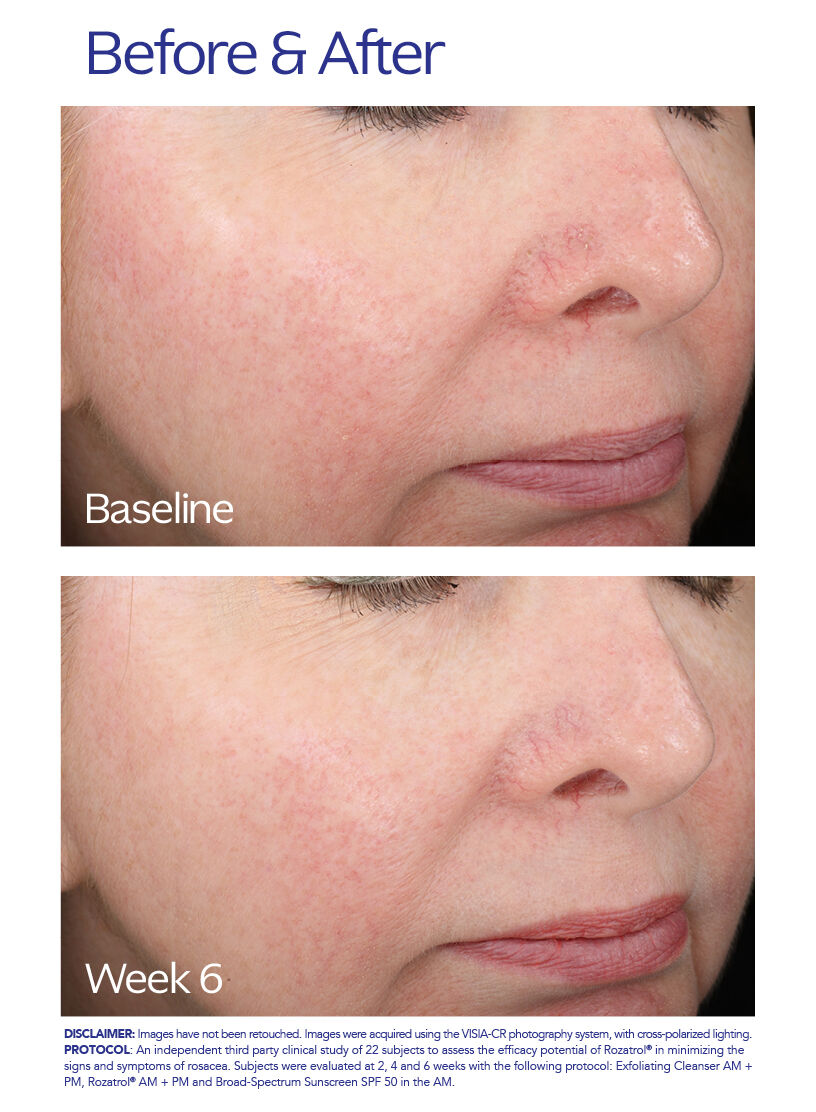 Rozatrol for Red Sensitized Skin