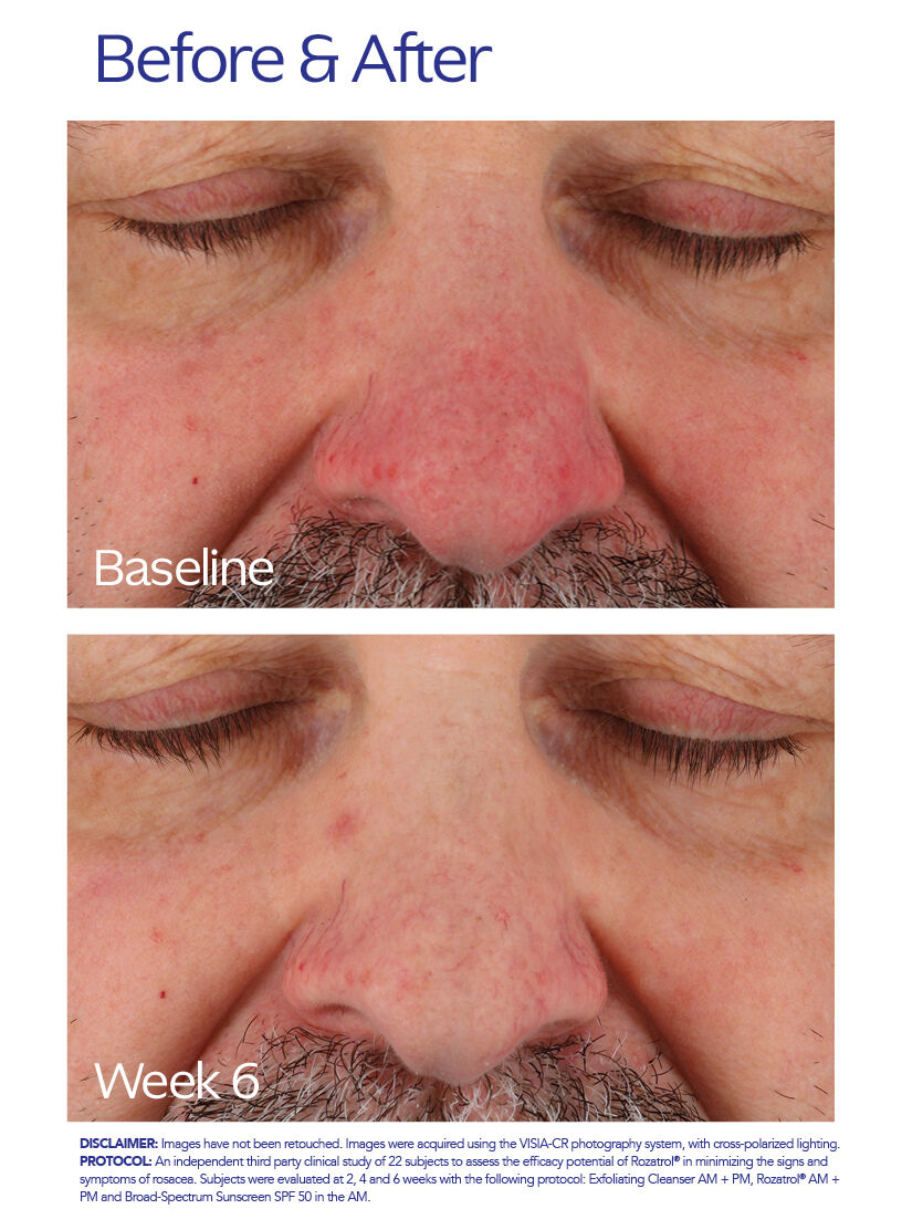 Rozatrol for Red Sensitized Skin